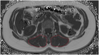 Associations Between Lumbar Vertebral Bone Marrow and Paraspinal Muscle Fat Compositions—An Investigation by Chemical Shift Encoding-Based Water-Fat MRI